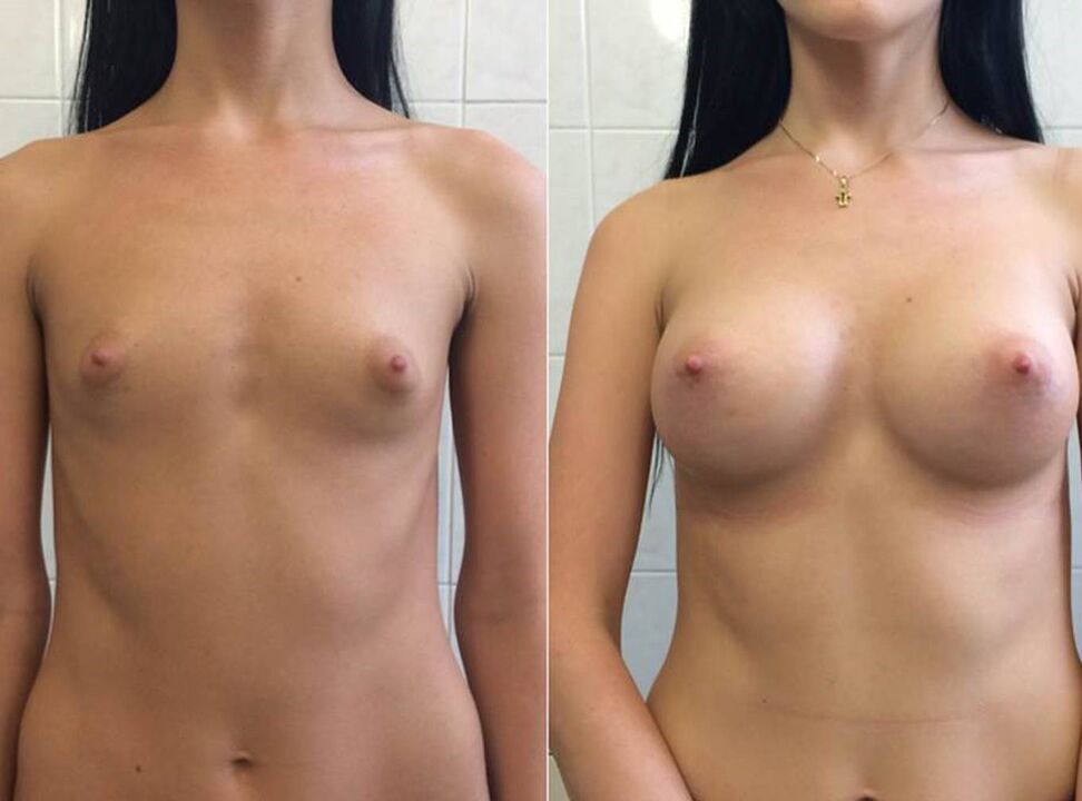 Fotos antes y después de usar la crema Wow Bust de Anna de Berlín